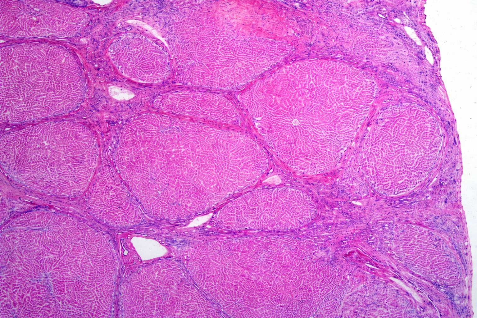 Fettleber heilen: Ist eine vollständige Regeneration möglich?